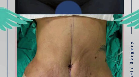 Tummy Tuck + Liposuction